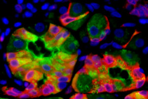 Similarities found in cancer initiation in kidney, liver, stomach, pancreas