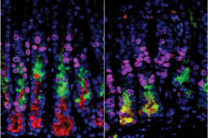 New insight into origin of stomach cancer