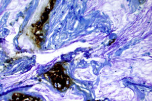 Biomarker predicts which pancreatic cysts may become cancerous